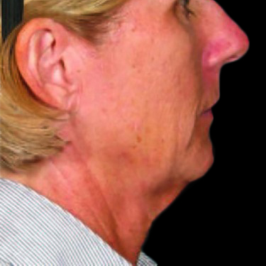 Case--21207 | Before Ultherapy Face
