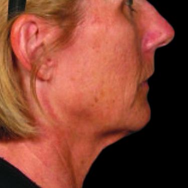 Case--21207 | After Ultherapy Face