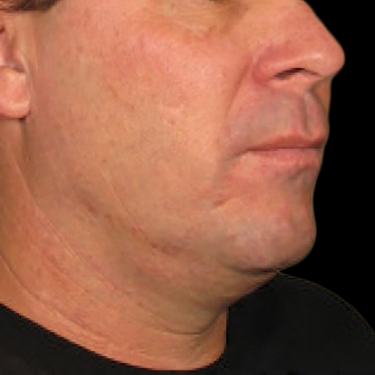 Case--21208 | Before Ultherapy Face