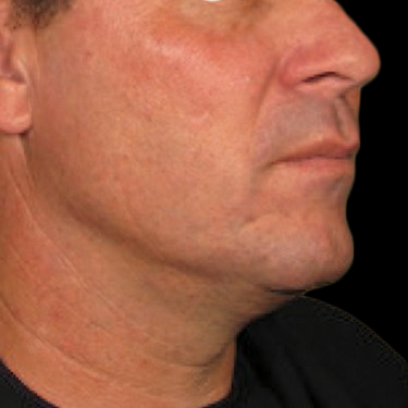 Case--21208 | After Ultherapy Face