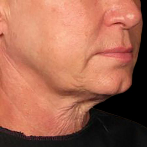 Case--21210 | Before Ultherapy Face
