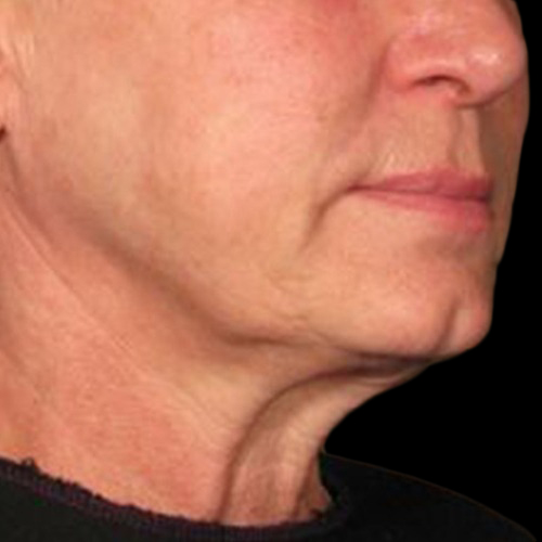 Case--21210 | After Ultherapy Face