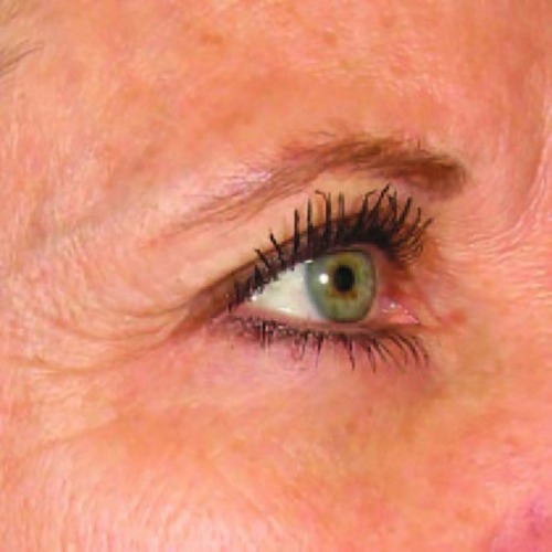 Case--21211 | Before Ultherapy Face