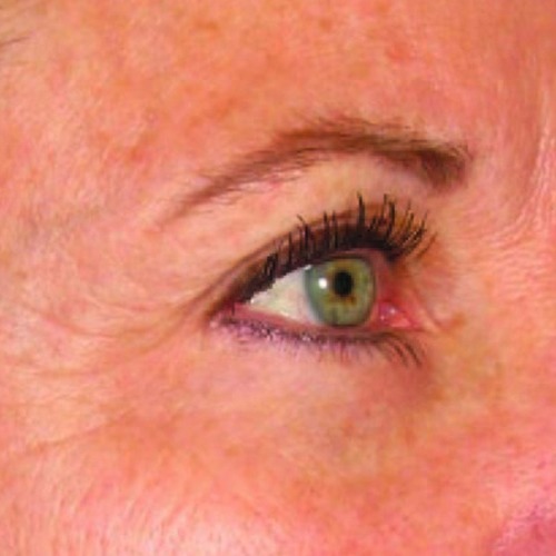 Case--21211 | After Ultherapy Face