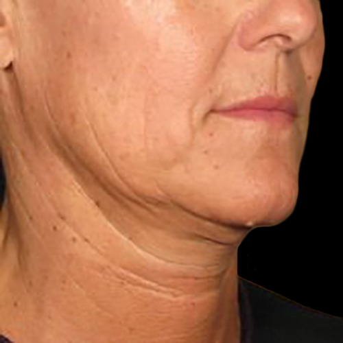 Case--21212 | Before Ultherapy Face
