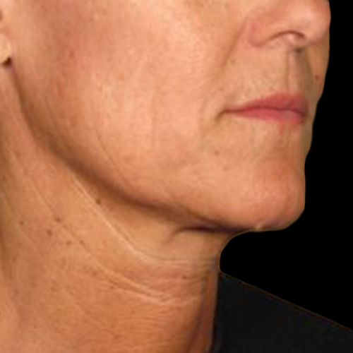 Case--21212 | After Ultherapy Face