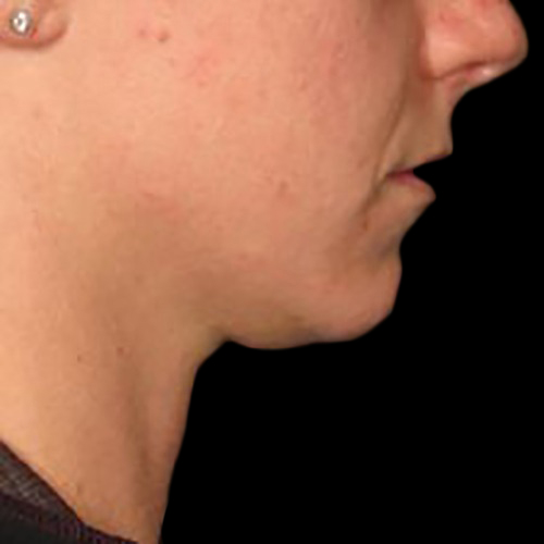 Case--21216 | Before Ultherapy Face