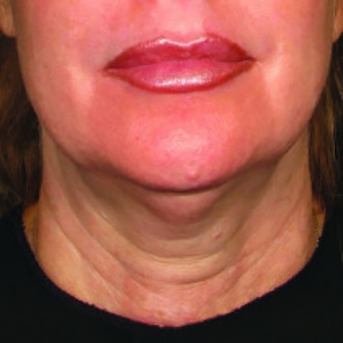 Case--21217 | Before Ultherapy Face