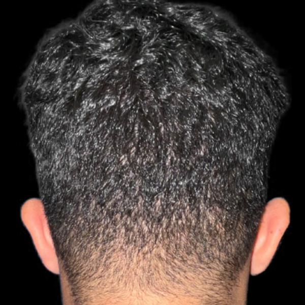 Case--21554 | After Face