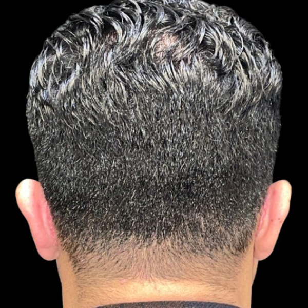 Case--21554 | Before Face