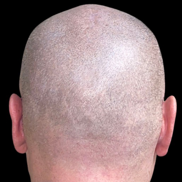 Case--21553 | After Face