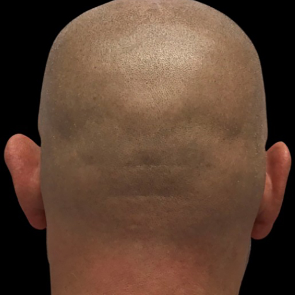 Case--21553 | Before Face