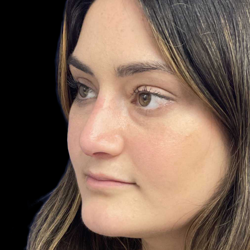 Case--21223 | After Face