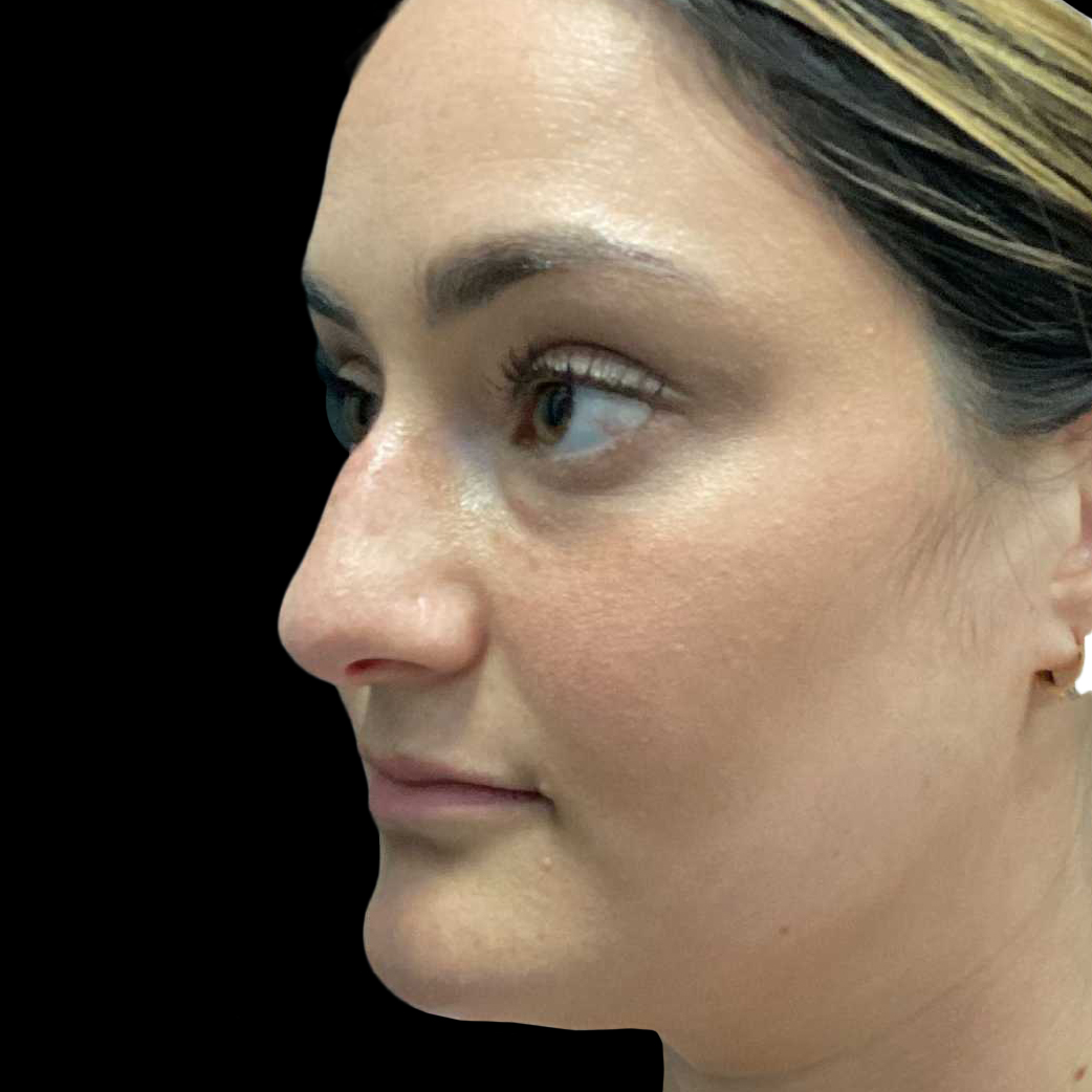 Case--21223 | Before Face