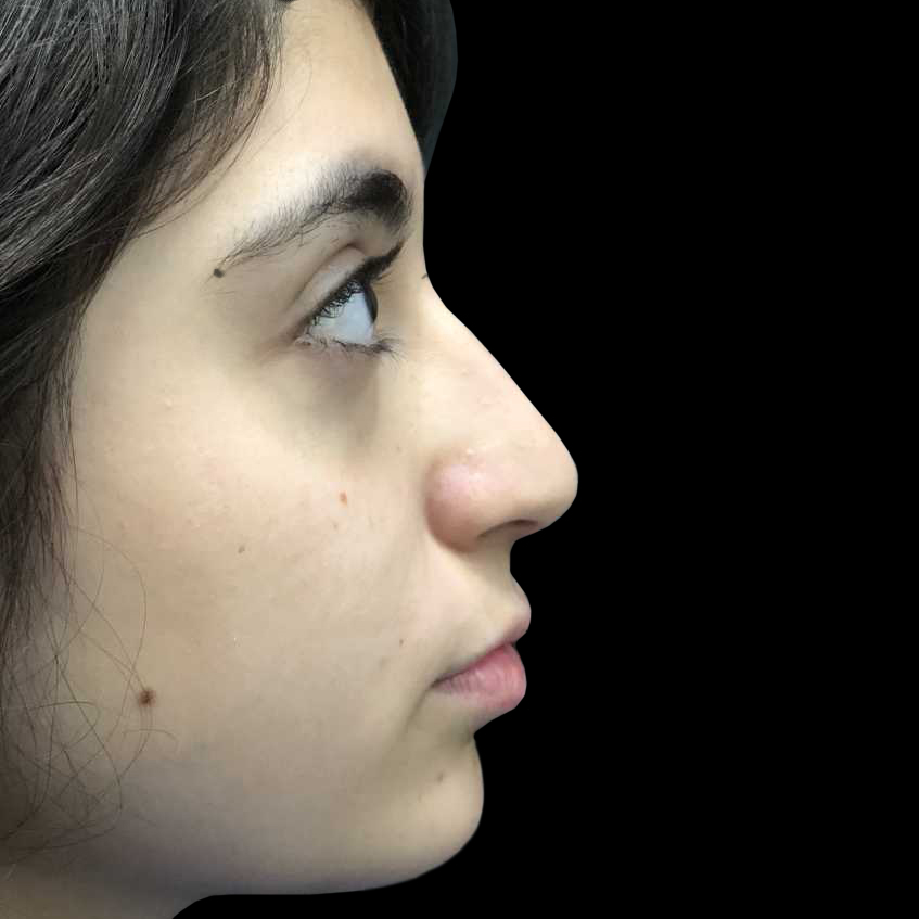 Case--19274 | Before Face