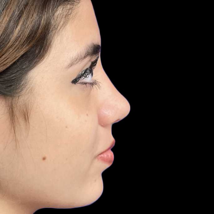 Case--19274 | After Face