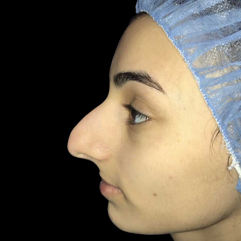 Case--19275 | Before Face