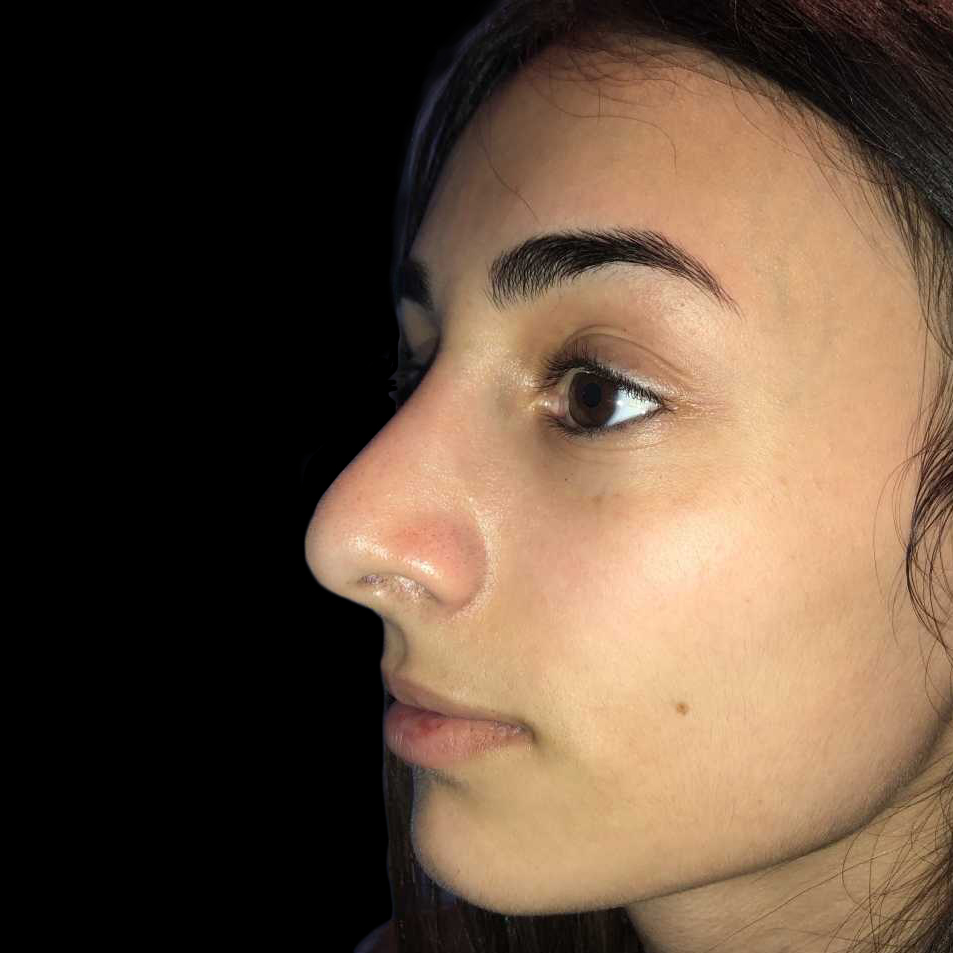 Case--19275 | After Face