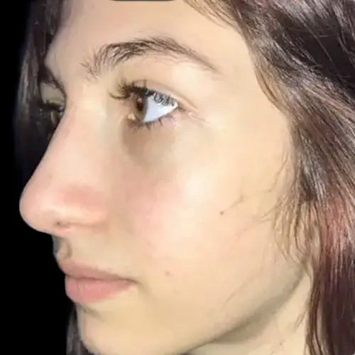 Case--19270 | After Face