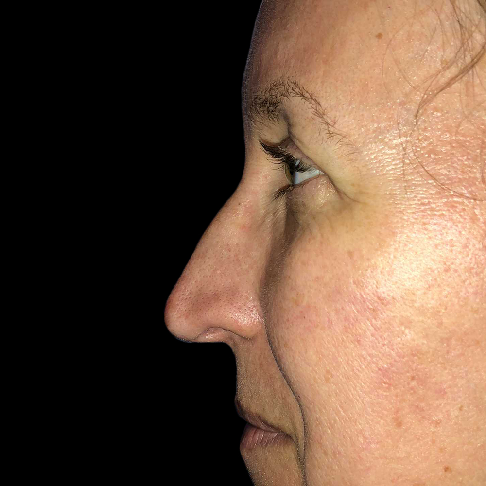 Case--19271 | Before Face