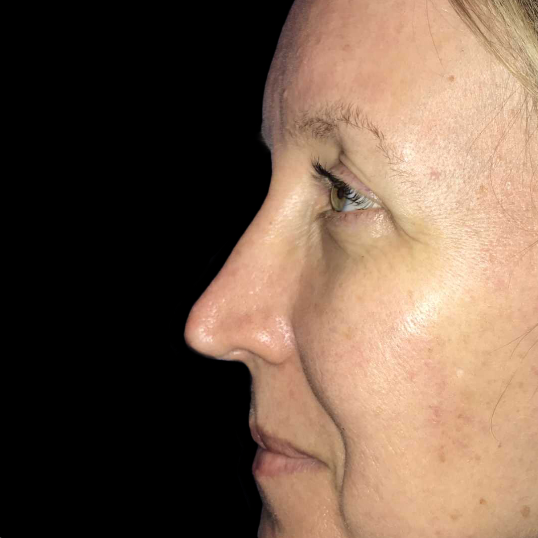 Case--19271 | After Face