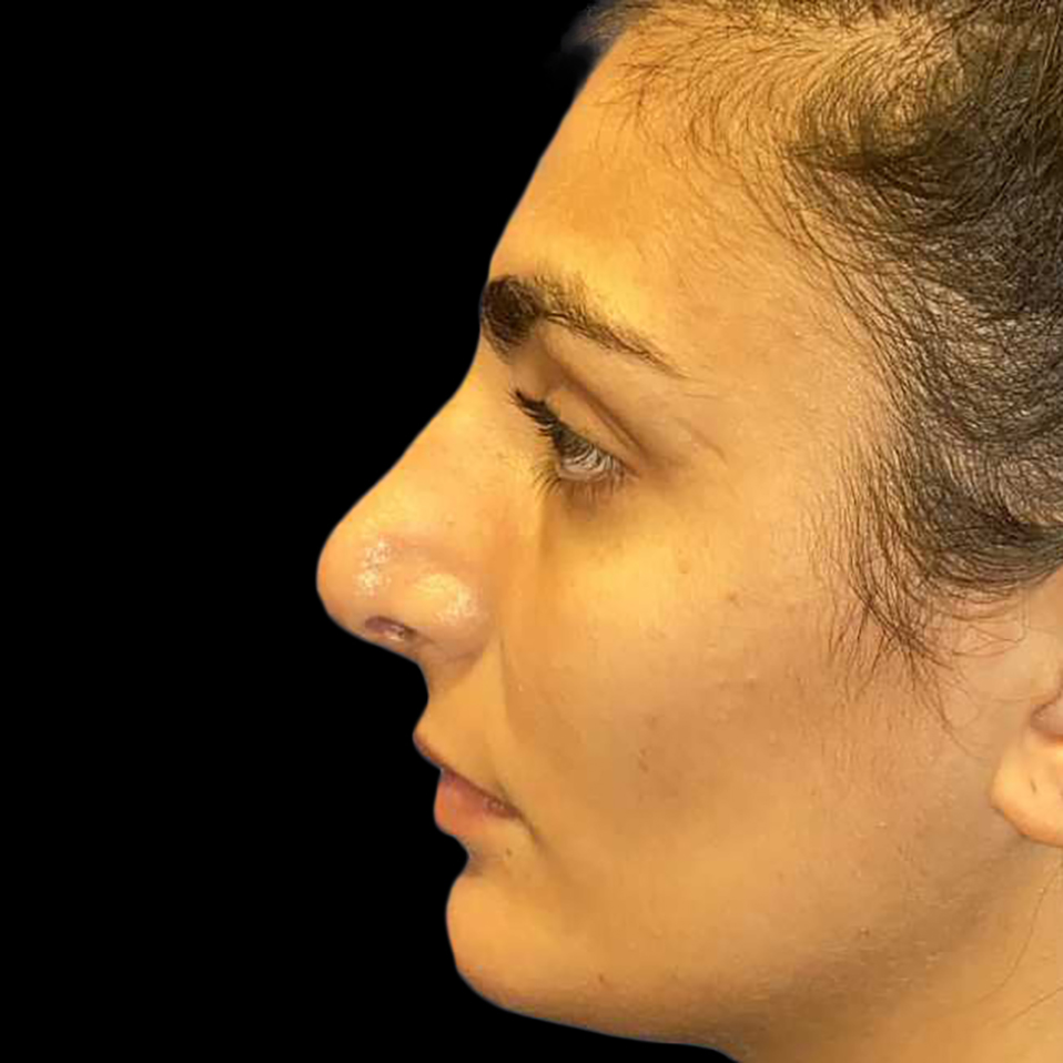 Case--19273 | After Face