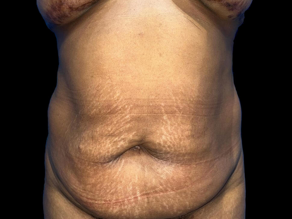 Case--21963 | Before Tummy Tuck