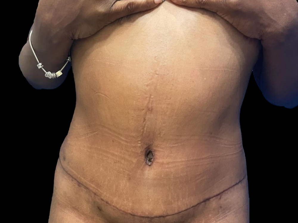 Case--21963 | After Tummy Tuck