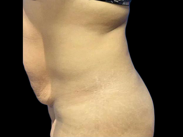 Case--21955 | Before Tummy Tuck