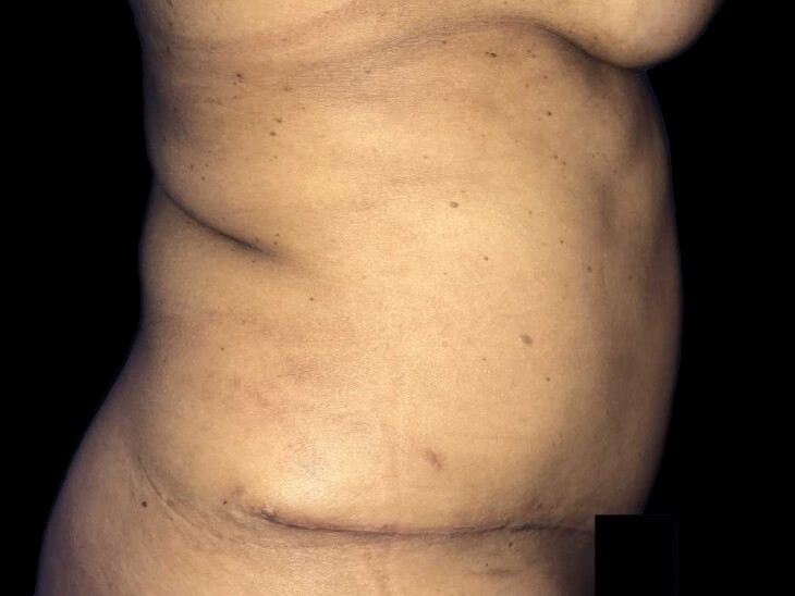 Case--21279 | After Tummy Tuck