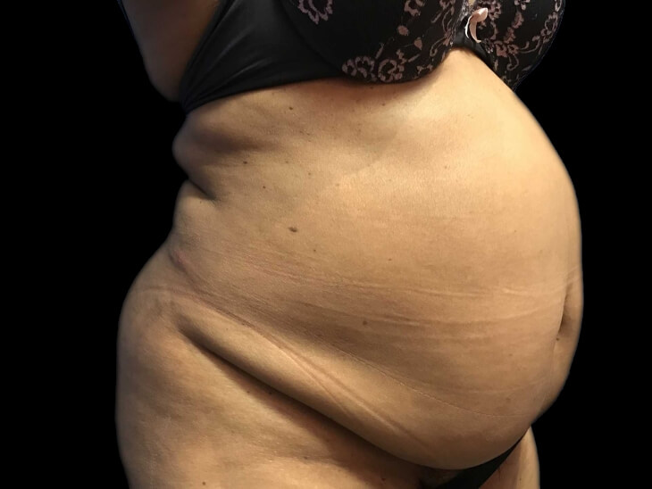 Case--21279 | Before Tummy Tuck