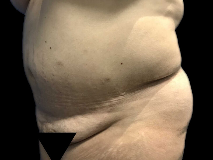 Case--19162 | Before Tummy Tuck