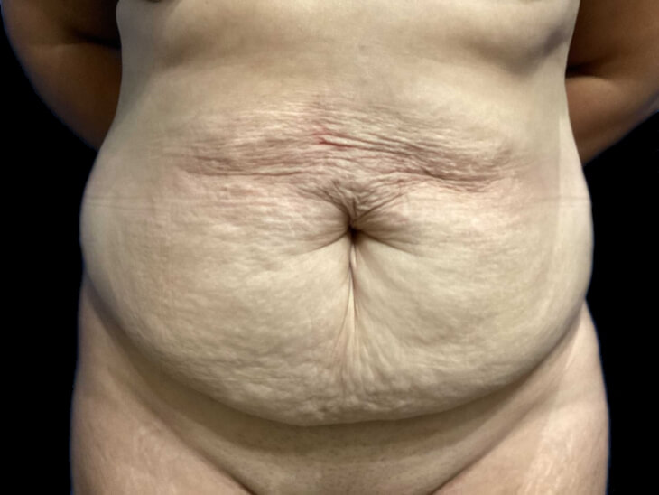 Case--19233 | Before Tummy Tuck