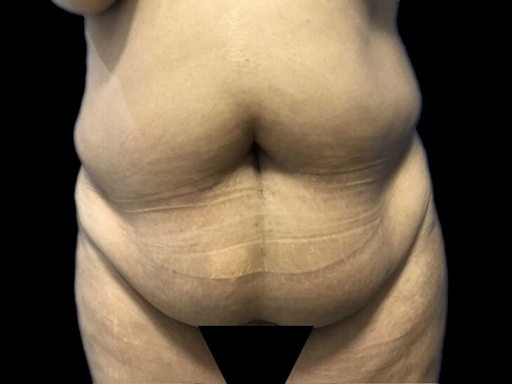 Case--19234 | Before Tummy Tuck