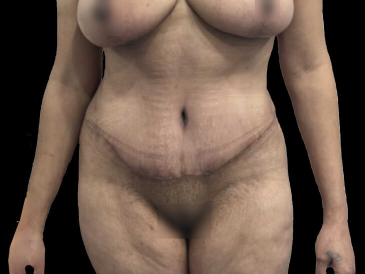 Case--19247 | After Tummy Tuck