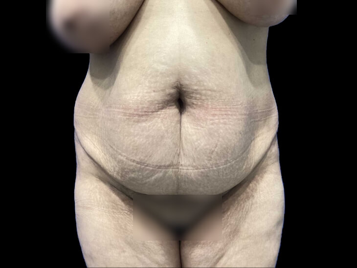 Case--19247 | Before Tummy Tuck