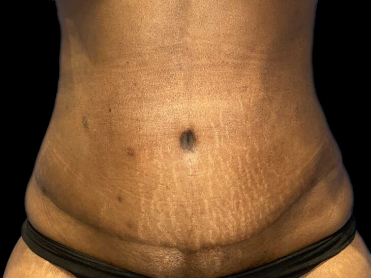 Case--19249 | After Tummy Tuck