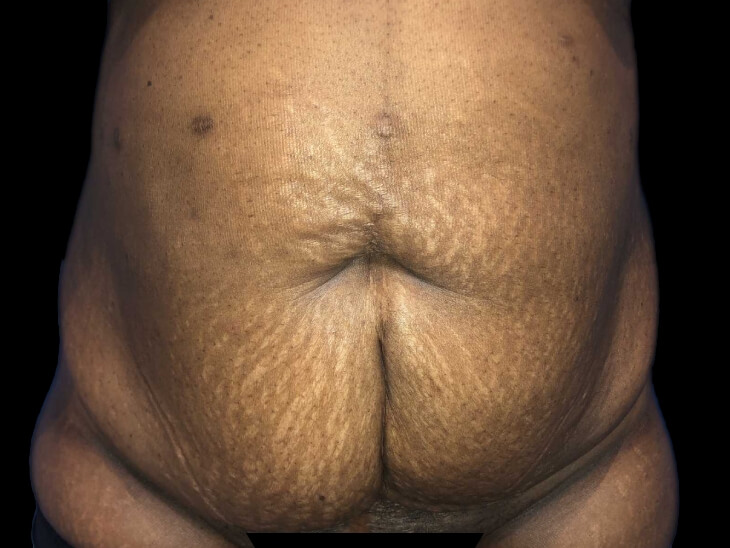 Case--19249 | Before Tummy Tuck