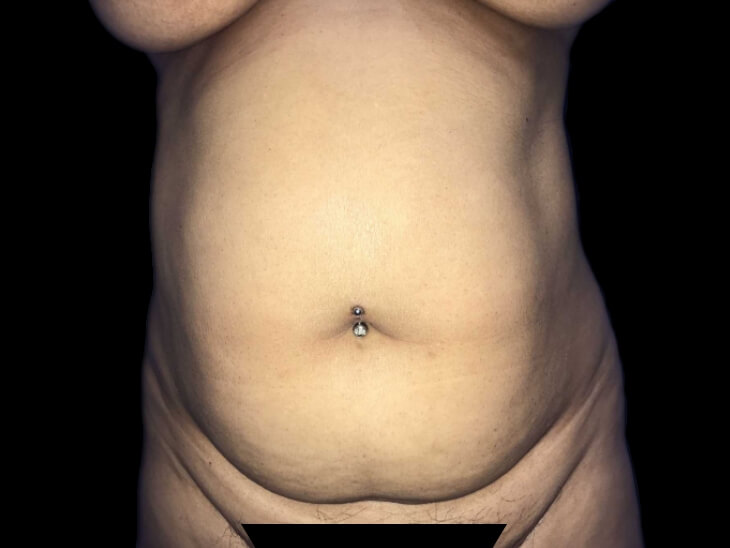 Case--19251 | Before Tummy Tuck