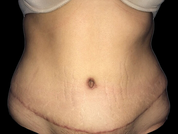 Case--21278 | After Tummy Tuck