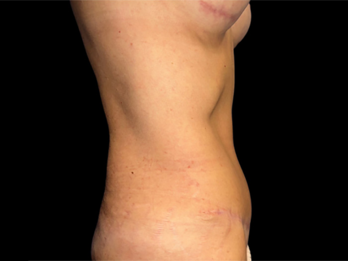 Case--5661 | After Tummy Tuck