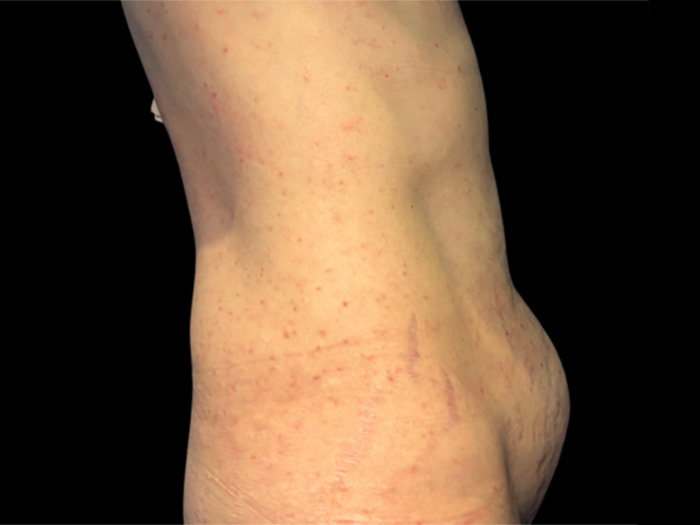 Case--5661 | Before Tummy Tuck