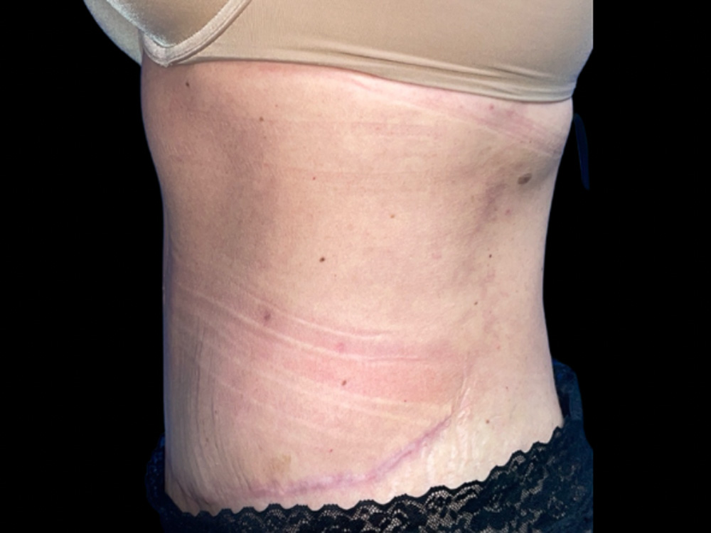 Case--7950 | After Tummy Tuck