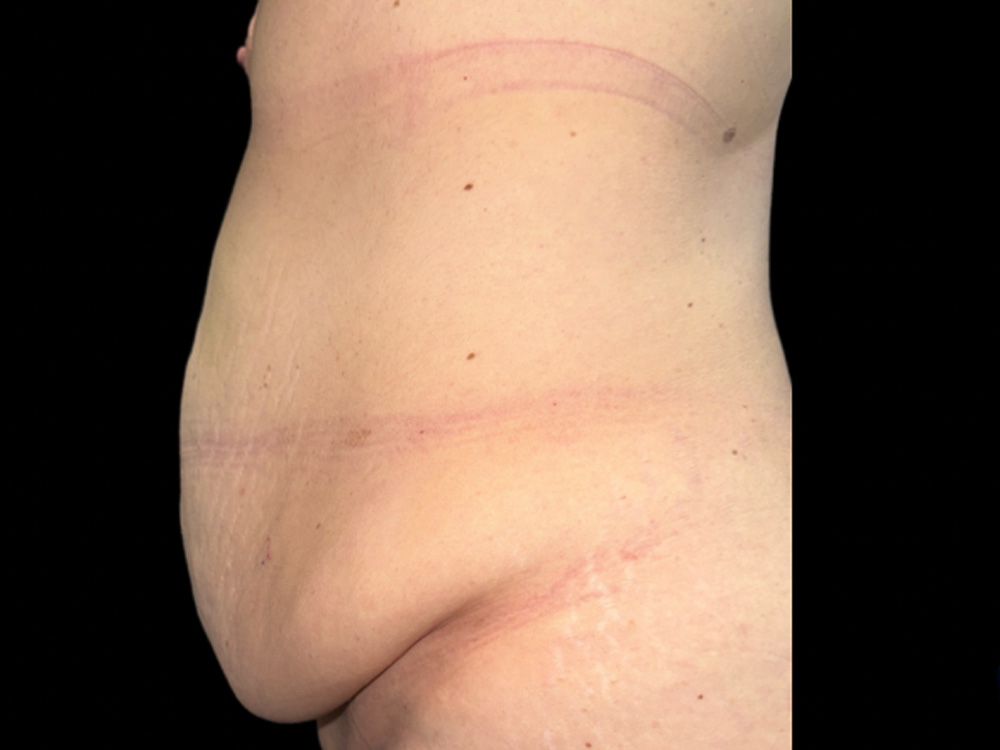 Case--7950 | Before Tummy Tuck