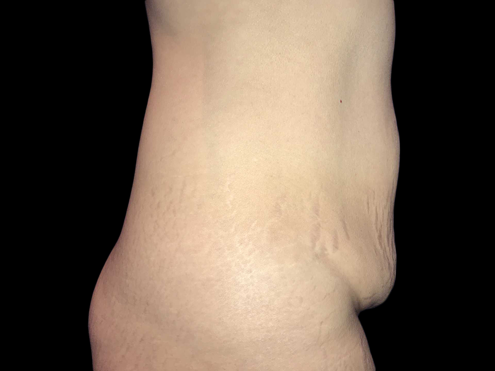 Case--19236 | Before Tummy Tuck