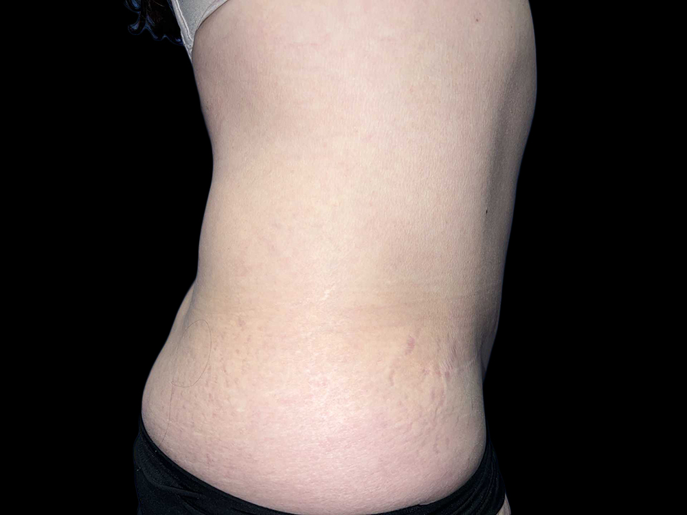 Case--19236 | After Tummy Tuck