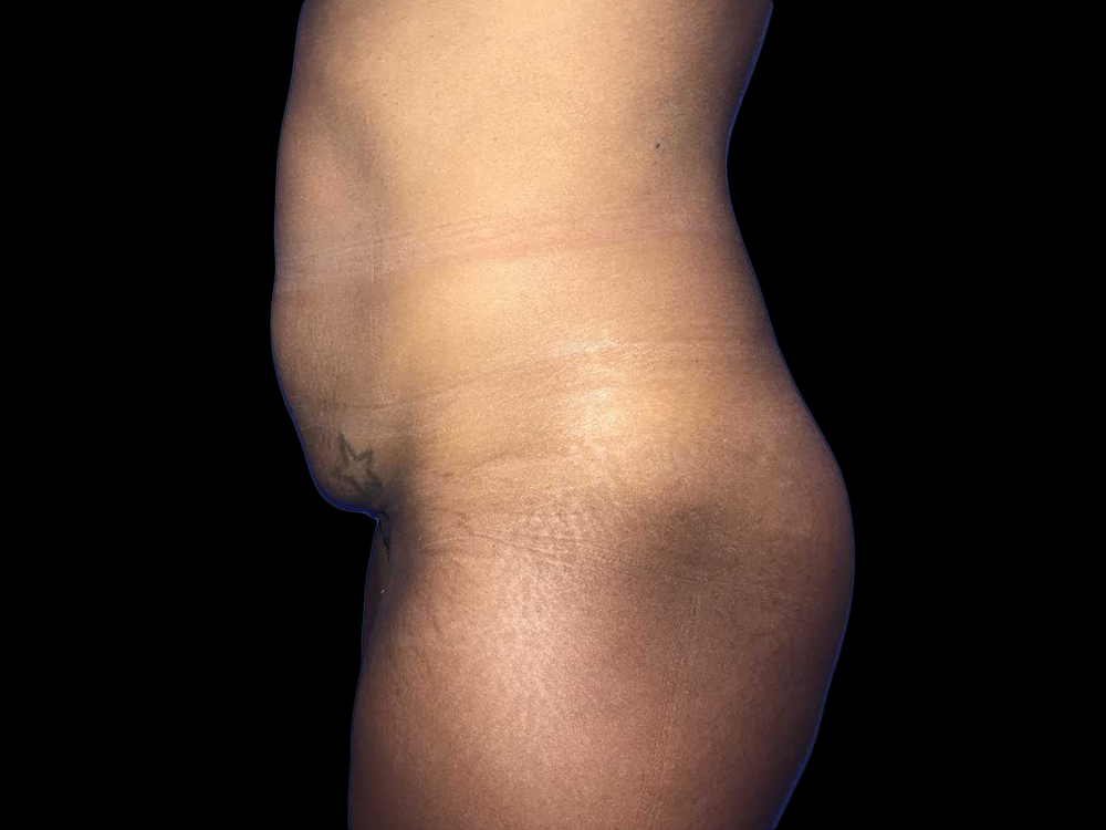 Case--19248 | Before Tummy Tuck