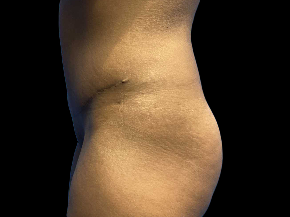 Case--19248 | After Tummy Tuck