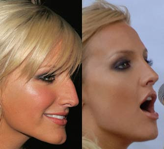 ashlee simpson nose job