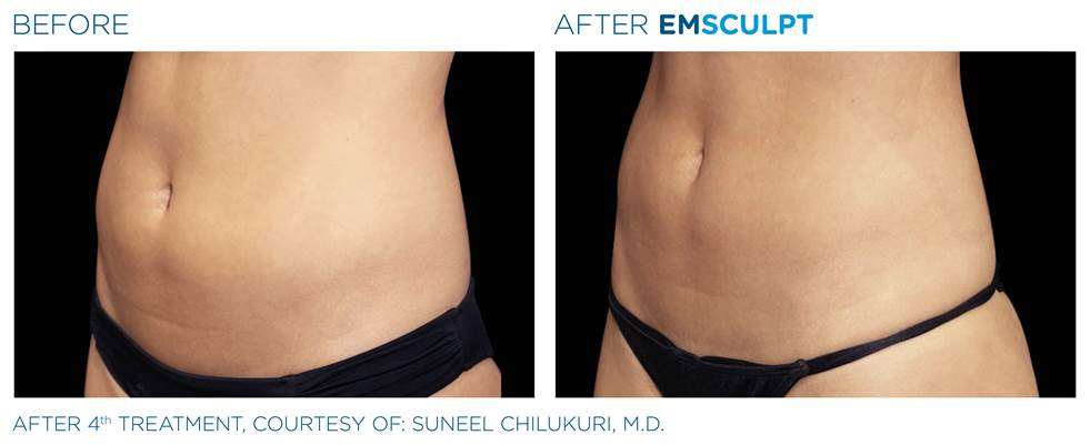 emsculpt before and after